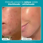 ژل ضدجوش سراوی مدل Blemish Control حجم 40میل - تصویر 2